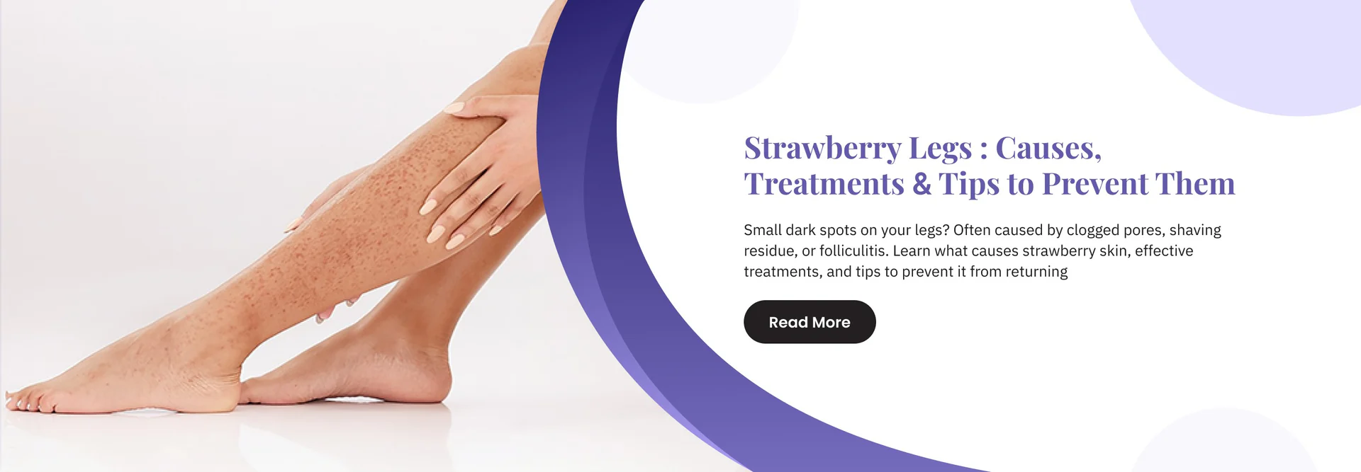Strawberry_Legs___Causes_Treatments_Tips_to_Prevent_Them_1 (1)